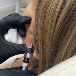 Biorevitalización Facial