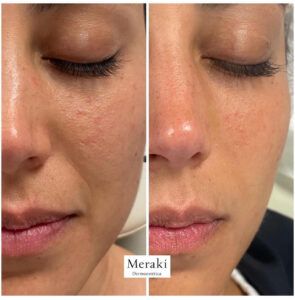 Peeling químico