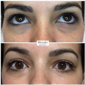 Corrección Ojeras