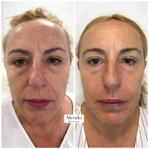 Full Face