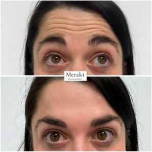 BOTOX SANTANDER
