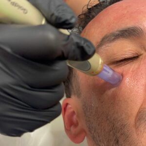Microneedling