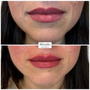 Aumento de Labios