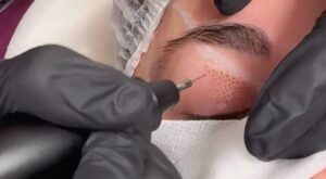 plasmapen